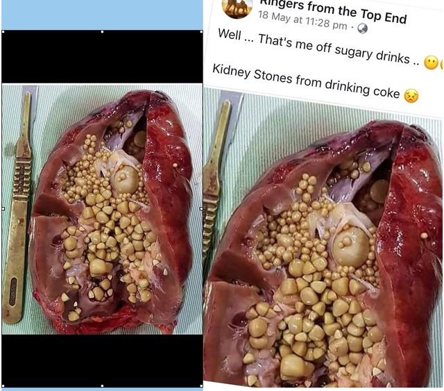 Will Drinking Cause Kidney Stones