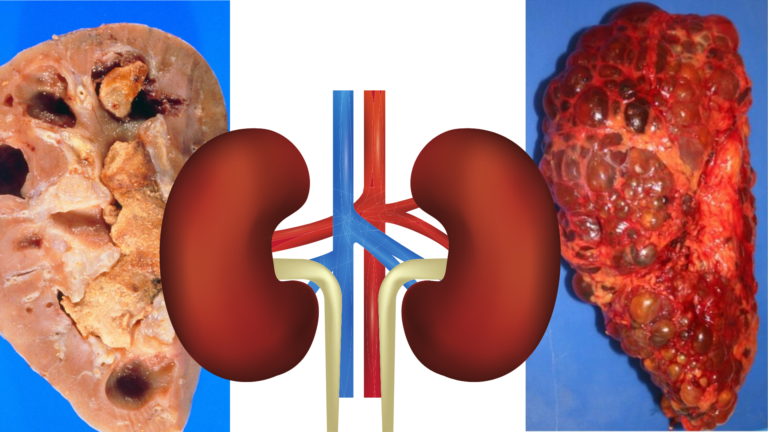 Your Kidneys and Uric Acid