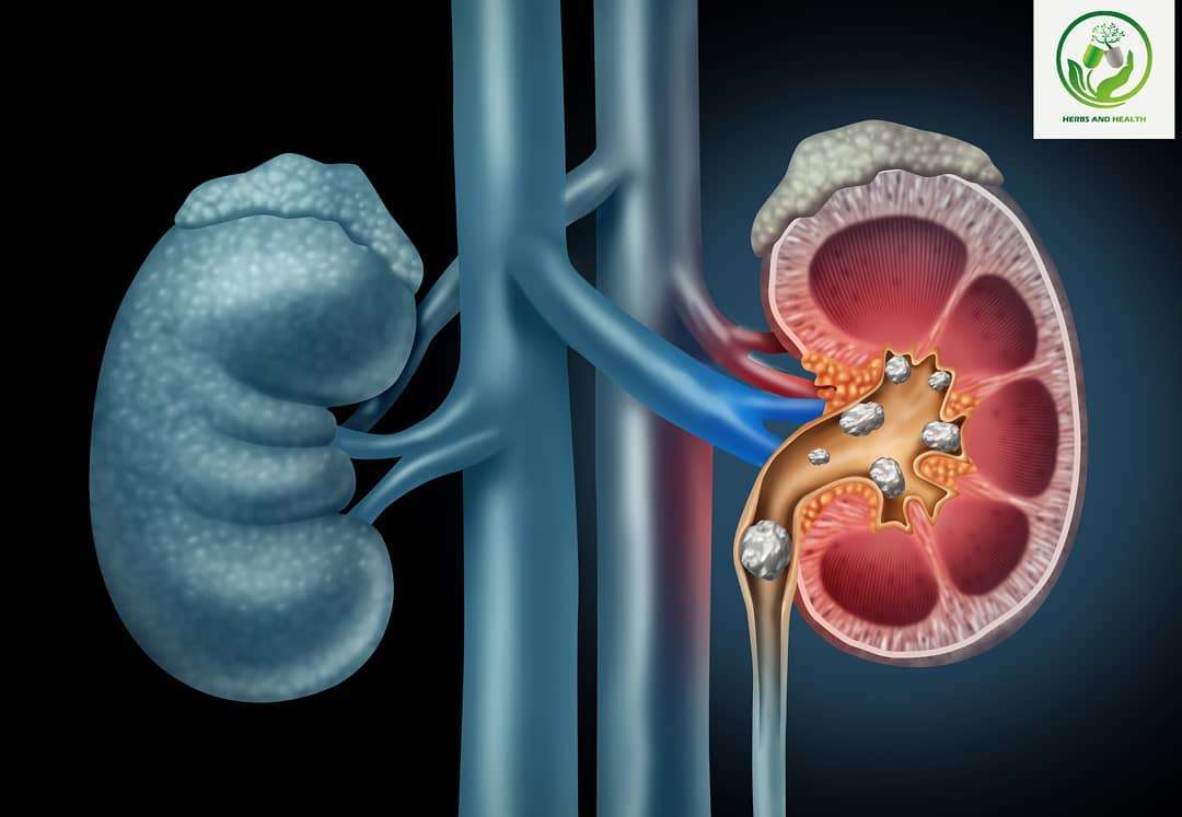 Your kidneys remove waste and fluid from your blood to make urine ...
